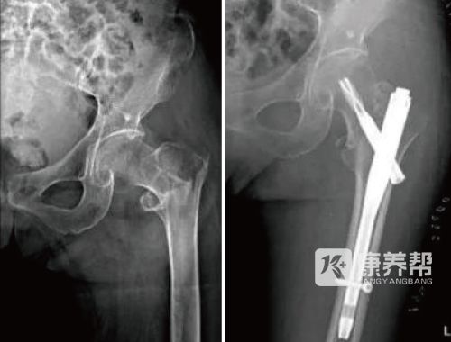 【骨科案例】髋部骨折救治：让老年人告别“人生最后一次骨折”(图2)