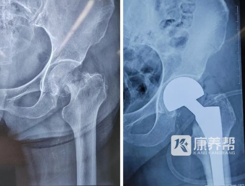 【骨科案例】髋部骨折救治：让老年人告别“人生最后一次骨折”(图4)